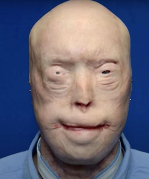 Firefighter has face transplant after third-degree burns & survives against all odds – see him now, 7 years later