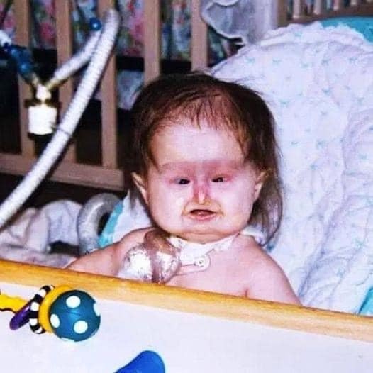 Baby Born With Unusual Syndrome – 22 Years Later She Looks Amazing