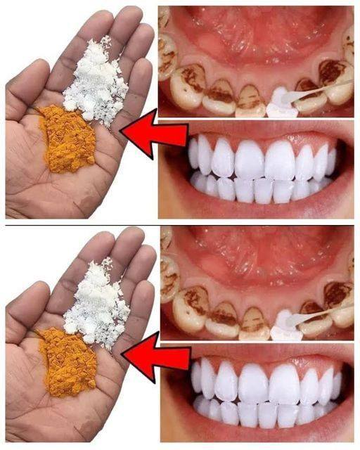 Teeth whitening in just 2 minutes – turning yellow and accumulated tartar into milk-like white and shiny.