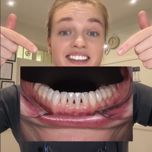 Dentist explains what it means if you have black triangles between your teeth