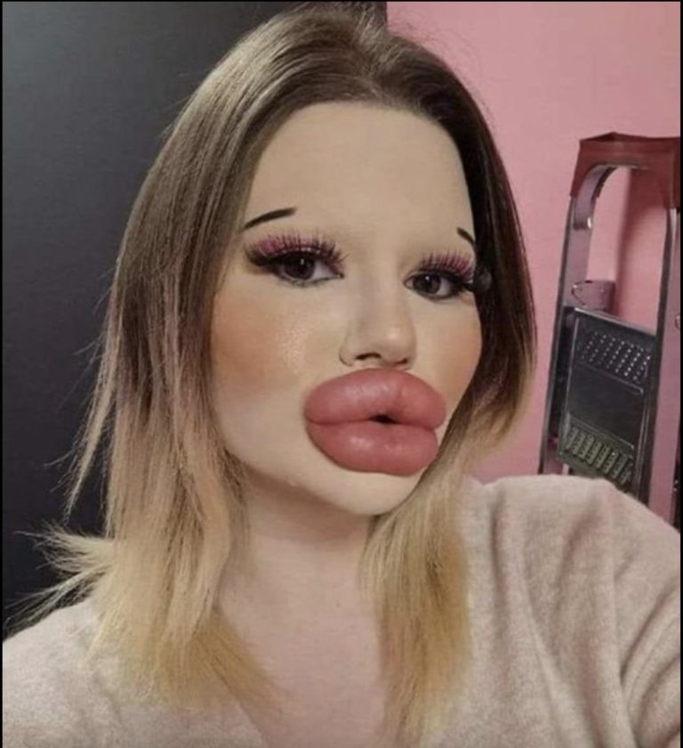 24-year-old woman wants the biggest lips in the world