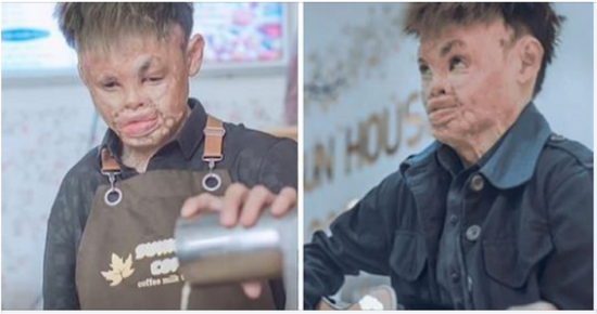 Burn survivor who didn’t leave home for 2 years now owns his own bakery – “I am more than how I look”