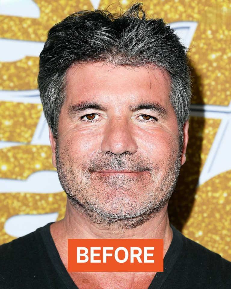 AGT Star Simon Cowell Removed His Facial Fillers After Not Recognizing Himself, Before And After Photos