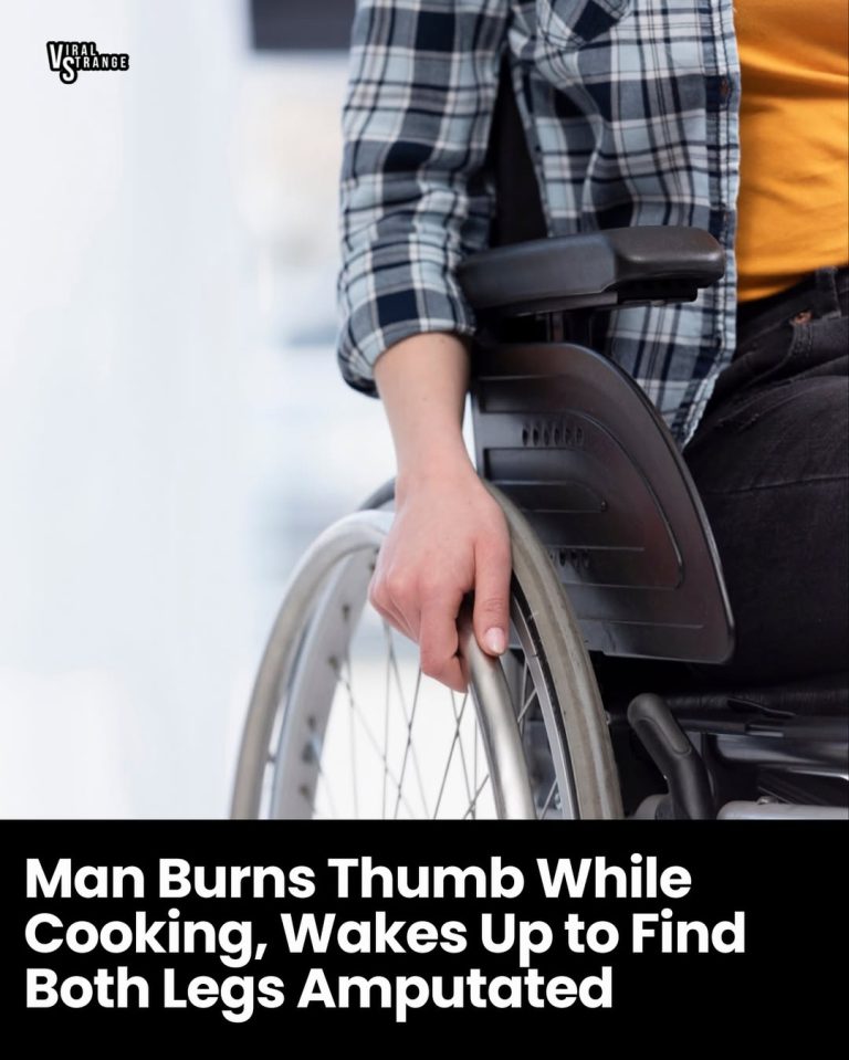 Man Burns Thumb While Cooking, Wakes Up to Find Both Legs Amputated