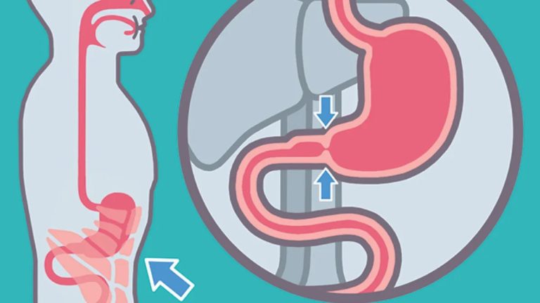 Health Body’s Vomiting Mechanism: A Fascinating Simulation