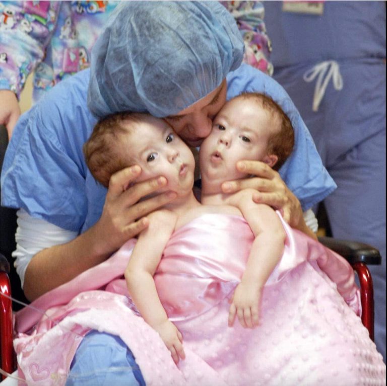 Conjoined twin sisters who were famously ”cut in half” in 2006 and became world pioneers are now living as separate adults.