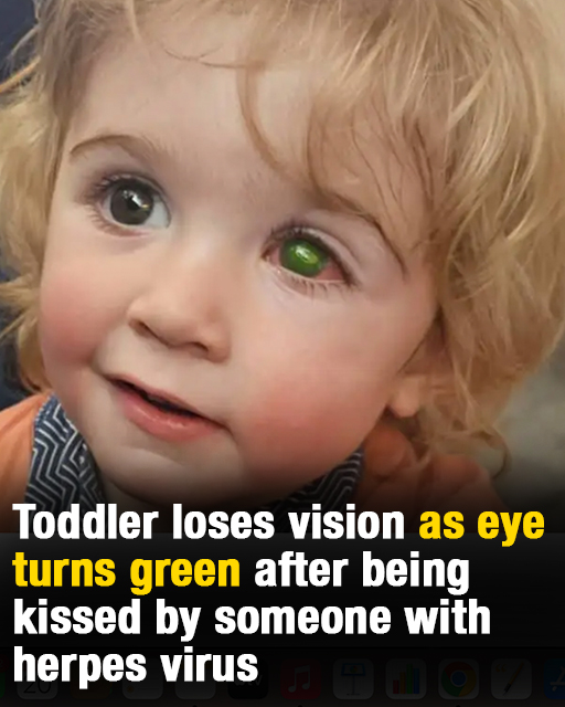 Toddler’s eye ”melts away” after wrong person kissed him