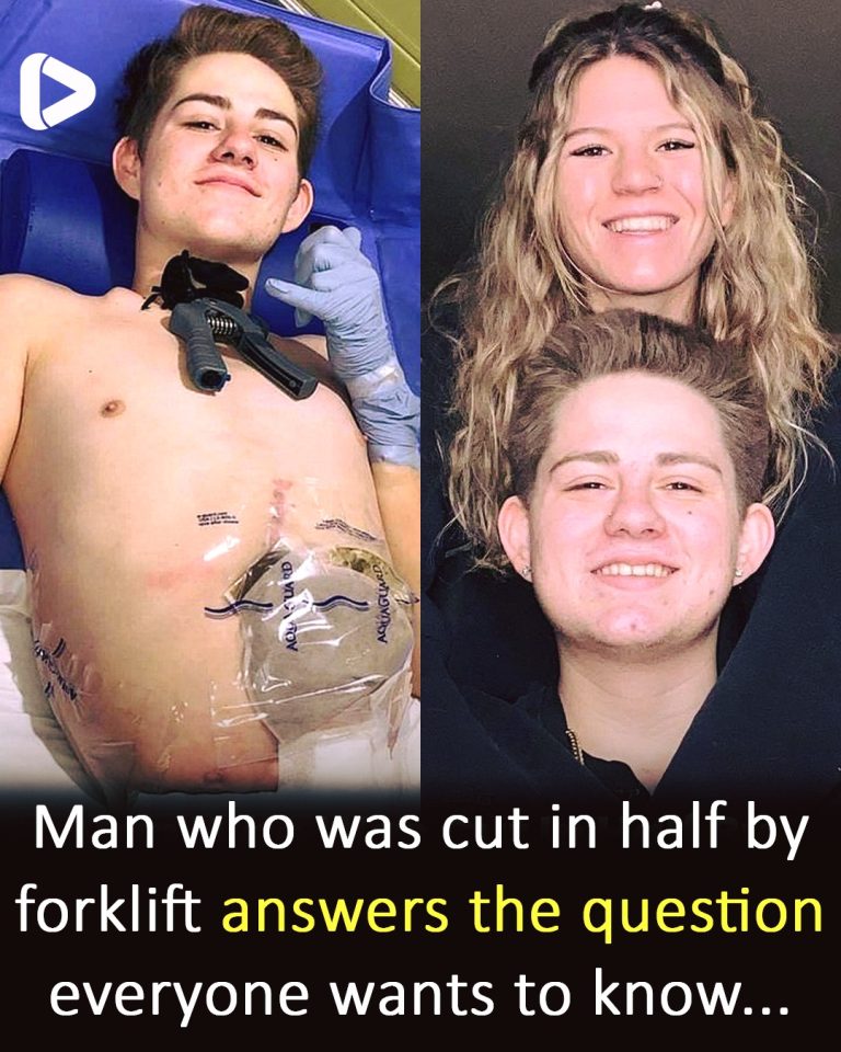 19-year-old crushed by forklift chooses to amputate bottom half of his body