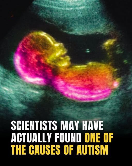 Study Suggests Key Link That Could Help Explain Autism Development