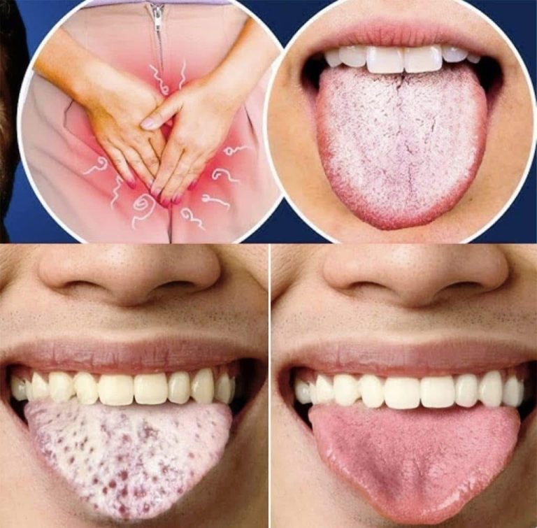 11 Things Your Tongue is Telling You About Your Health