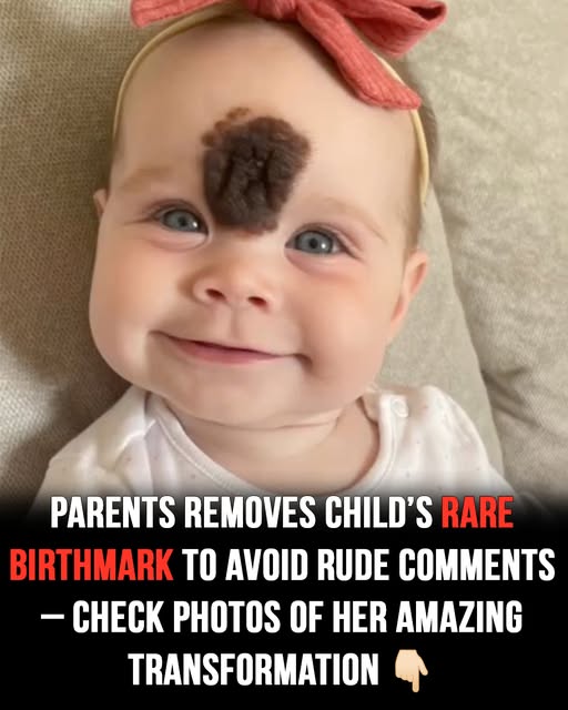 Cruel reactions force parents to remove baby’s rare birthmark
