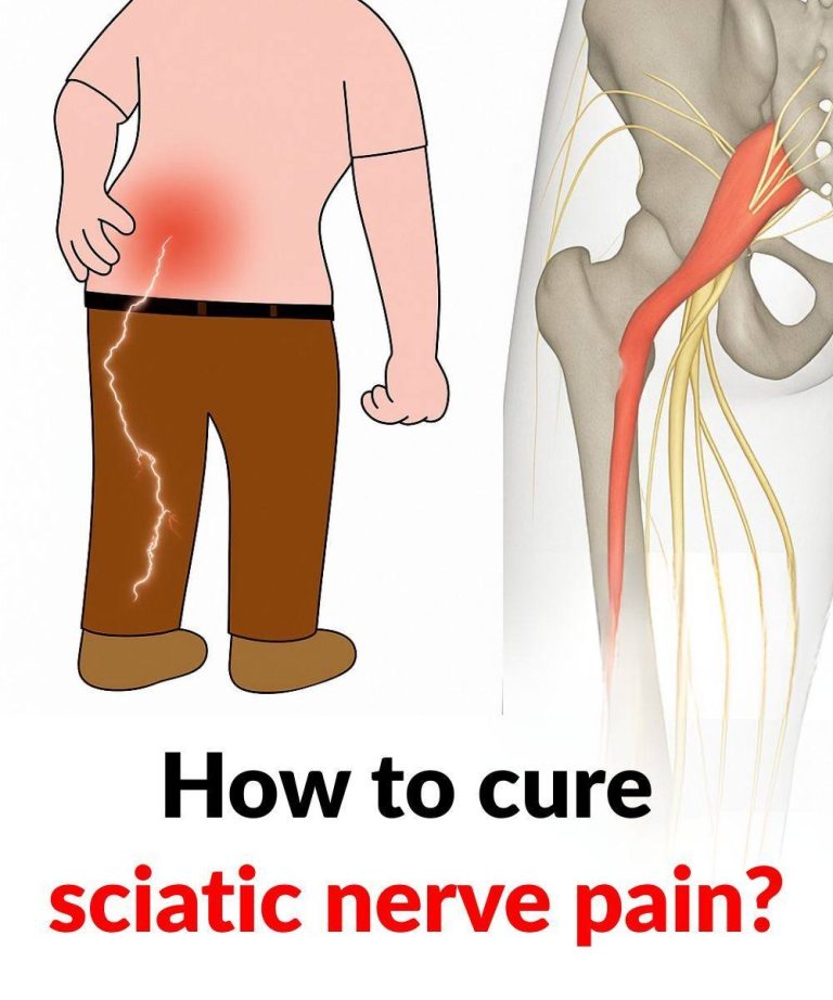 3 exercises to relieve sciatica pain in the leg: practical and effective