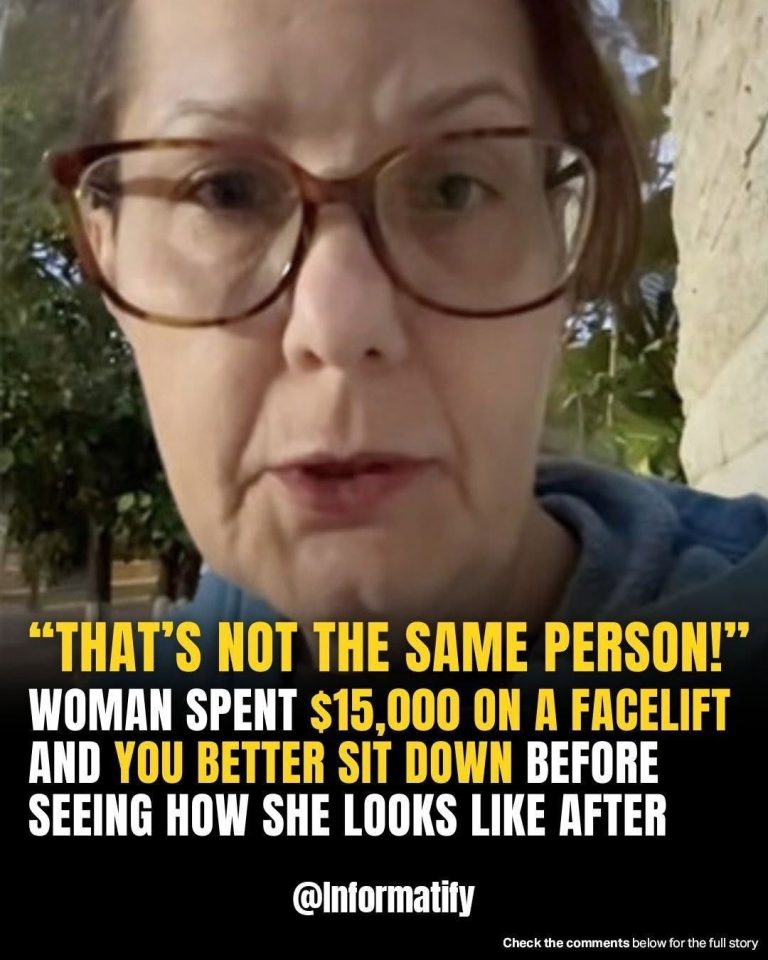 Facelifts Gone Viral: Woman Posts $15k Surgery Reveal—Reaction Is Intense