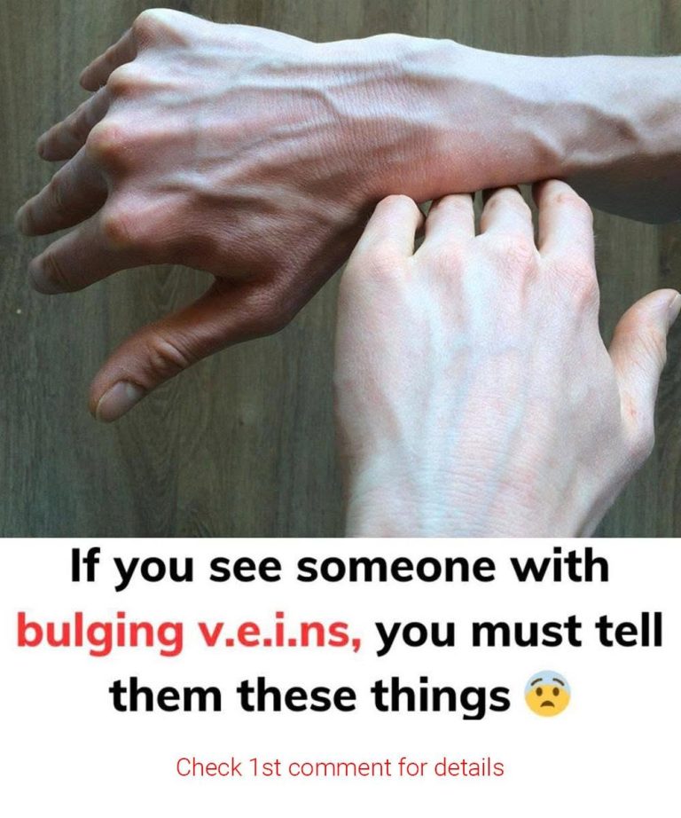 If you see someone with bulging veins, you must tell them these things