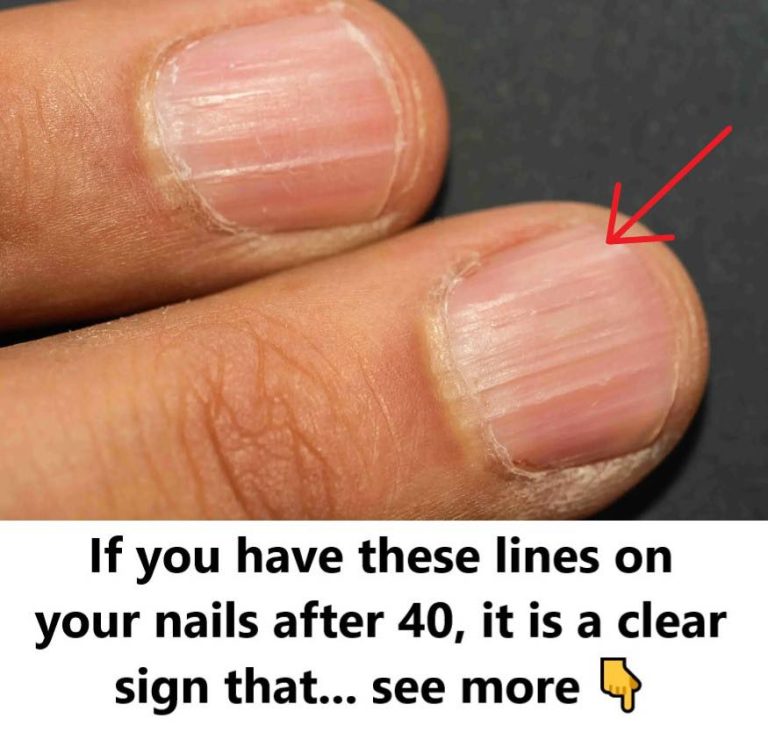 When you see these ridges on your nails after age 40, it’s an obvious warning – The Concealed Messages Behind Nail Appearances