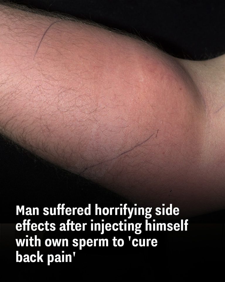Man suffered horrifying side effects after injecting himself with own sperm to ‘cure back pain’