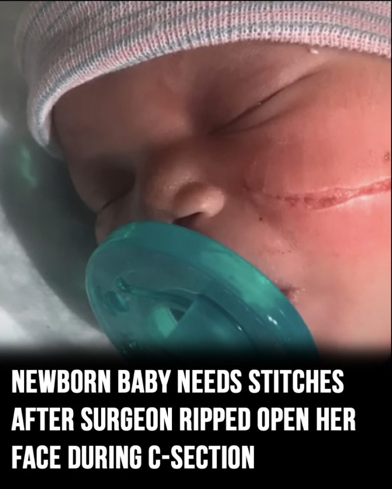 Newborn baby needs 13 stitches after surgeon ripped open her face during C-section