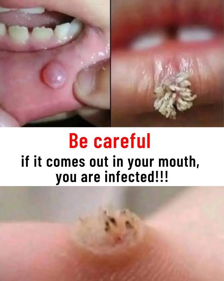 To BE VERY CAREFUL . If you get this, you are infected with