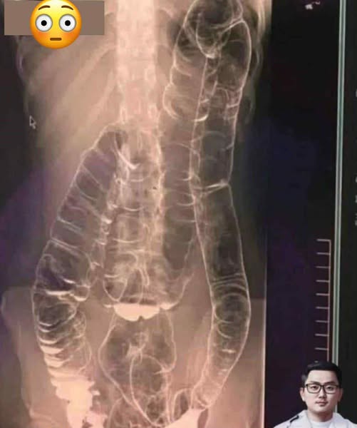 Everything you need to know about chronic constipation: A hidden threat to your digestive health