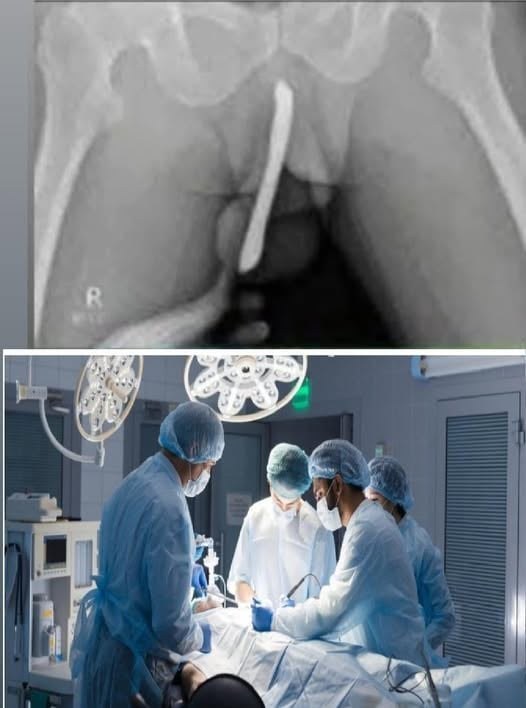 Girl had to be hospitalized for wanting to use a pe…