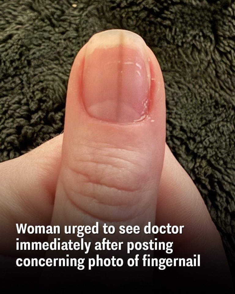 Woman urged to see doctor immediately after posting concerning photo of fingernail