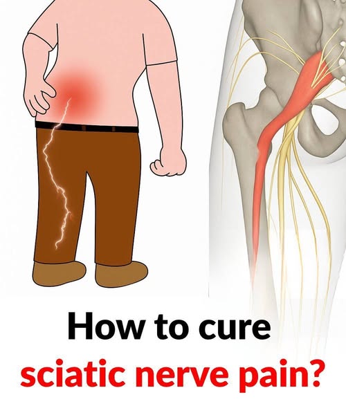3 exercises to relieve sciatica pain in the leg: practical and effective