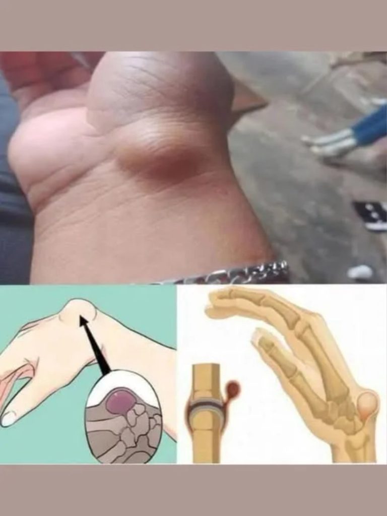 If You Get These Bruises on Your Body, It Might Mean Something