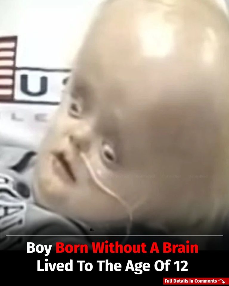 Boy Born Without A Brain Amazingly Lives Until Age 12