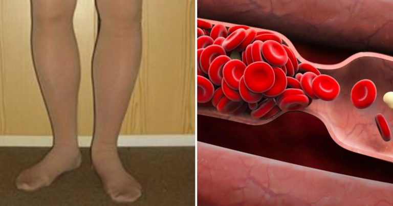 Your body warns you before a blood clot: 8 hidden signs you should never ignore