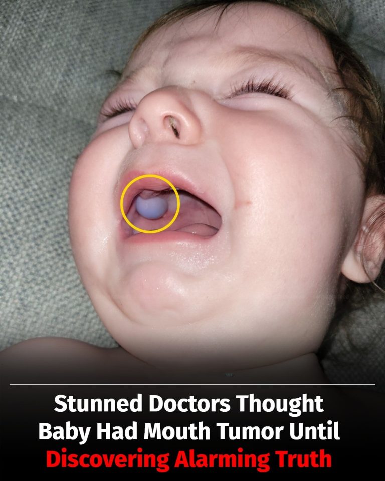 Doctors Were Shocked By What Looked Like A Tumor In Baby’s Mouth — But The Truth Was Totally Unexpected