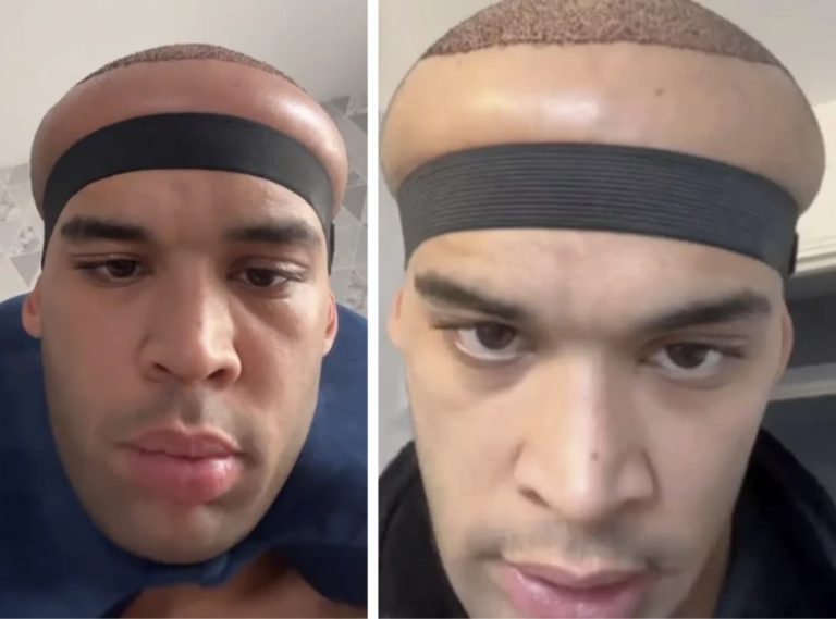 Man Issues Warning After Common Procedure Goes Horribly Wrong