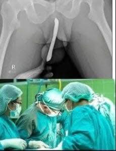 Girl had to be hospitalized for wanting to use a pe…See more