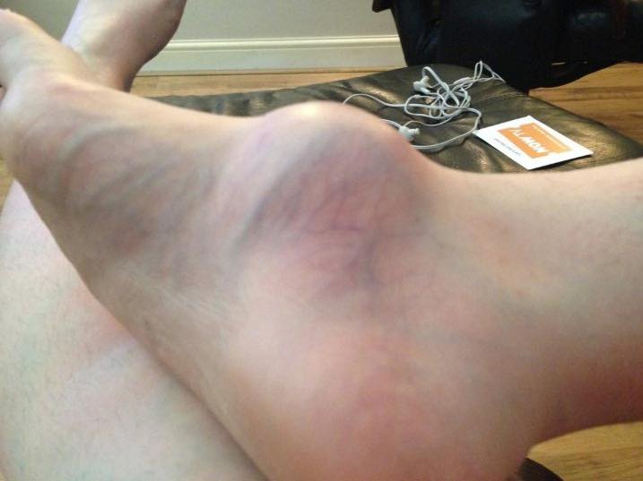 Woman’s foot was swollen for years, then she finally pays the doctor a visit to learn why
