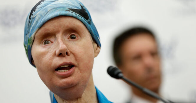 The sad story of Charla Nash, the woman whose face was ripped off by an chimpanzee