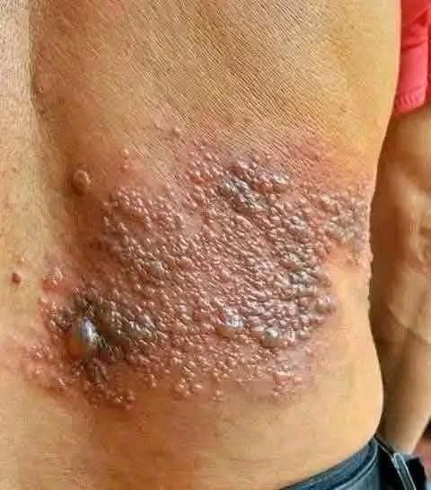 Young woman dies at the hands of her…See moreIt was itching his body, he thought it was an allergy, but a tough diagnosis… See more