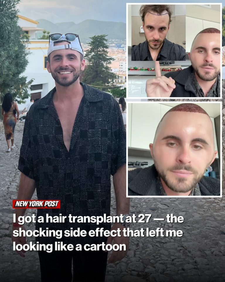 I got a hair transplant at 27 — the shocking side effect that left me looking like a cartoon