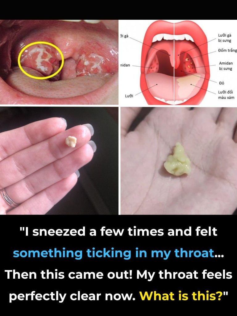 Here’s what you need to know about tonsil stones – the weird pimple-like growths in your throat