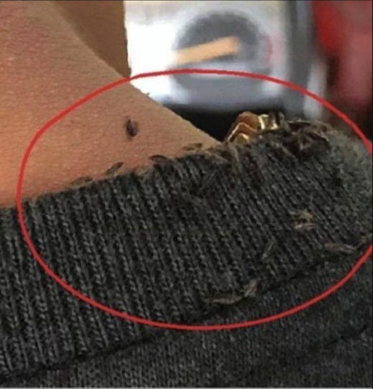 Man goes viral for extreme head lice infestation