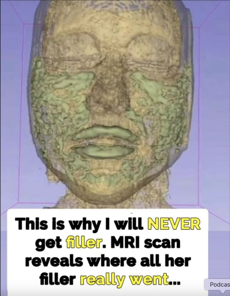 Plastic surgeon reveals damage fillers do in long term