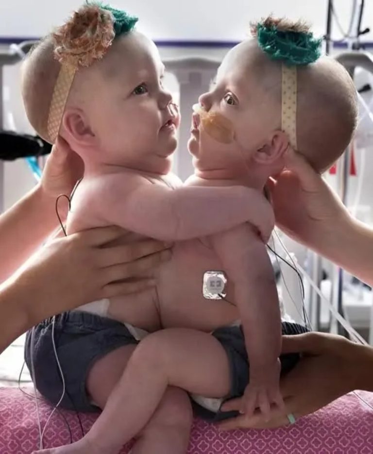 The twin sisters were born joined at the chest and abdomen: you will be shocked when you see them after the separation