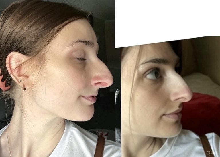 People Can’t Believe How This Woman Looks After Getting A $11k Nose Job