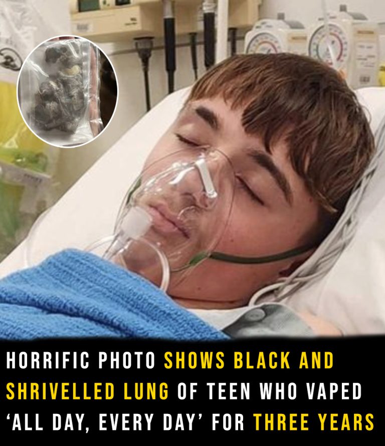 Photos shows shrivelled black lung of teen who vaped everyday