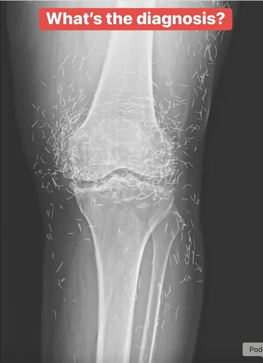 Doctors Shocked by What They Found Hidden Inside a Woman’s Knee X-Ray