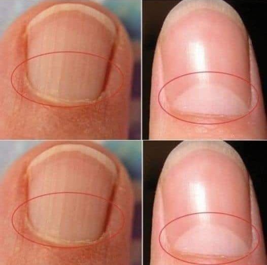 If your nails do not form a half-moon shape, see a doctor immediately.