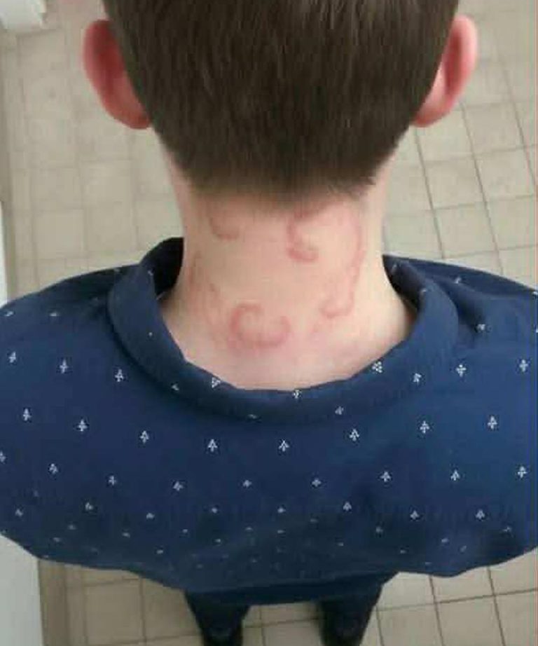 His whole body was itchy, he thought it was an allergy but then he was diagnosed