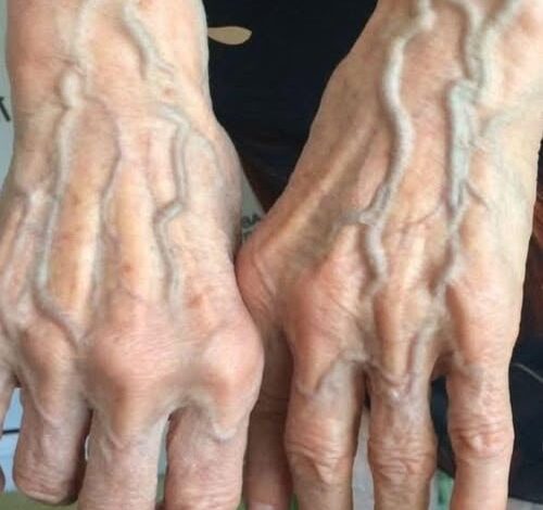 When to Worry About Veins That Appear Out of Nowhere!?