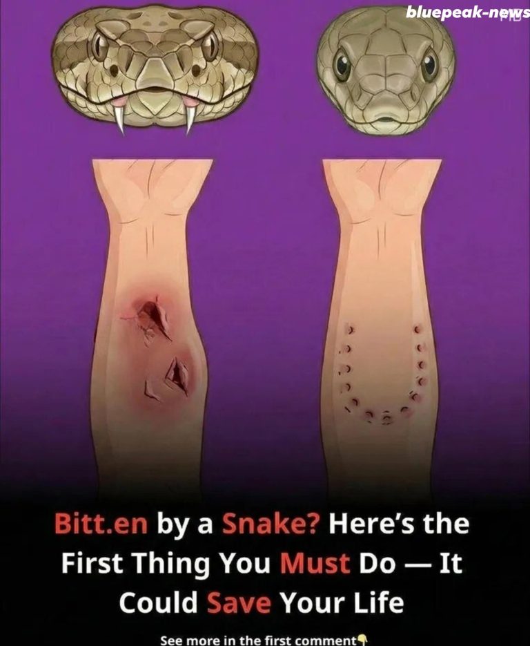 What to Do Following a Snakebite: Crucial First Aid Procedures That May Help
