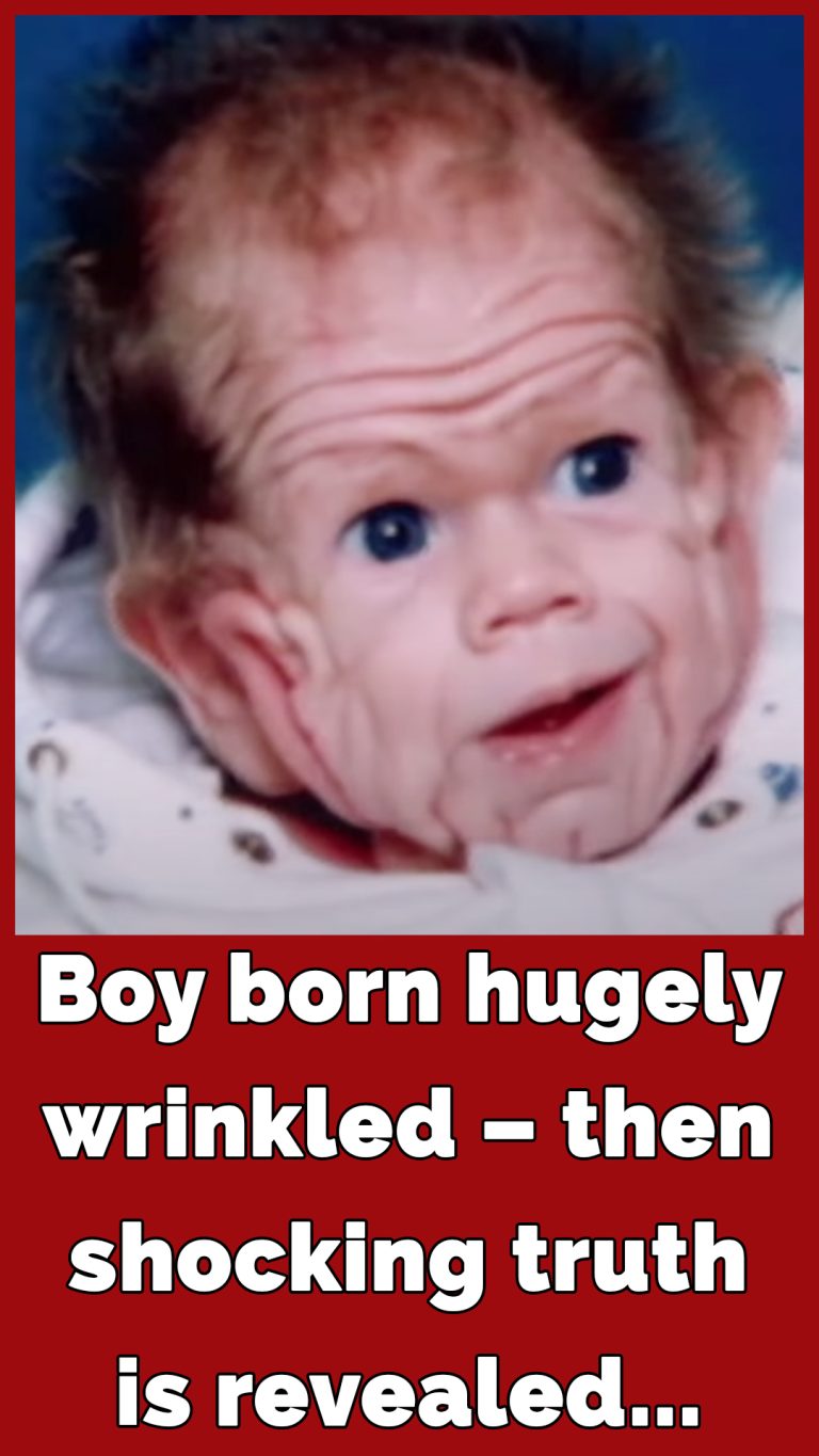 Tomm Tennent was born with enough skin for a five-year-old child