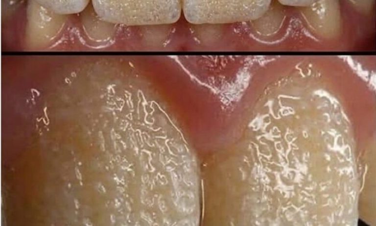 Be Careful! This Is What Can Happen to Your Teeth When You Eat Certain Everyday Foods and Drinks That Slowly Damage Enamel, Cause Staining, Increase Sensitivity, and Lead to Long-Term Dental Problems You Might Not Notice Until Its Too Late to Reverse the Effects!
