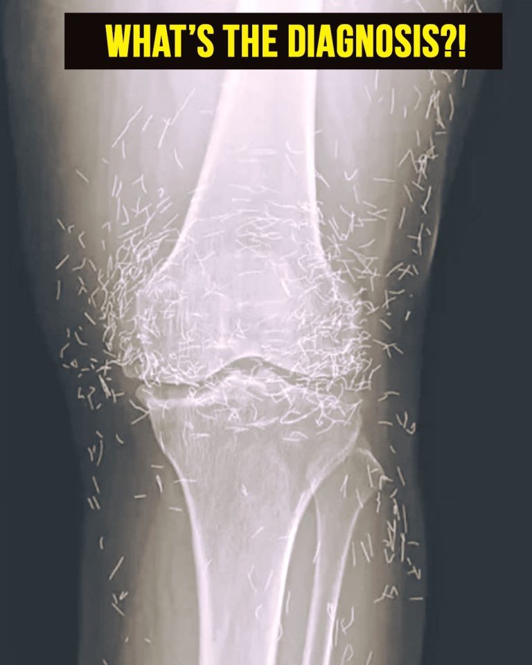 Doctors Discover Unexpected Treasure in Woman’s Knees